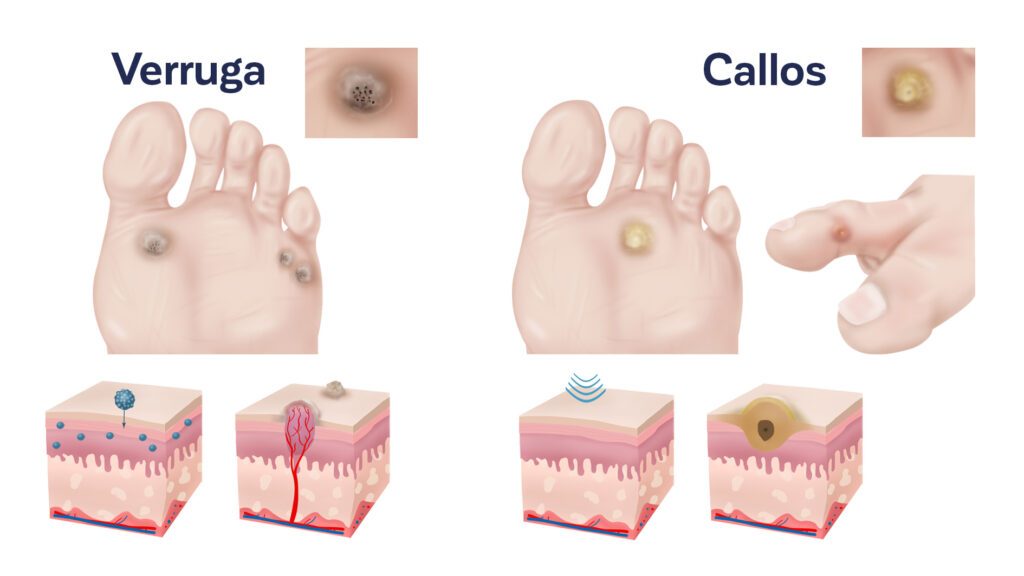 Verrugas en los pies tipos y tratamiento España
